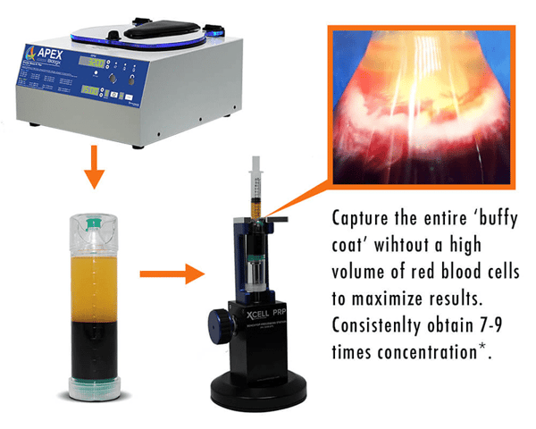 Understanding PRP injections